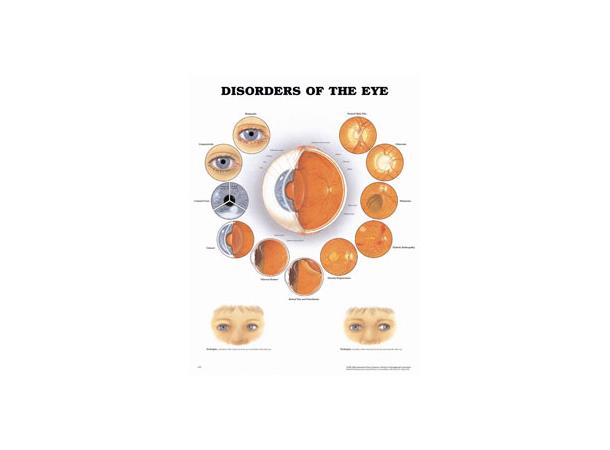 Disorders Of Eye Anatomical Chart Medicvision As